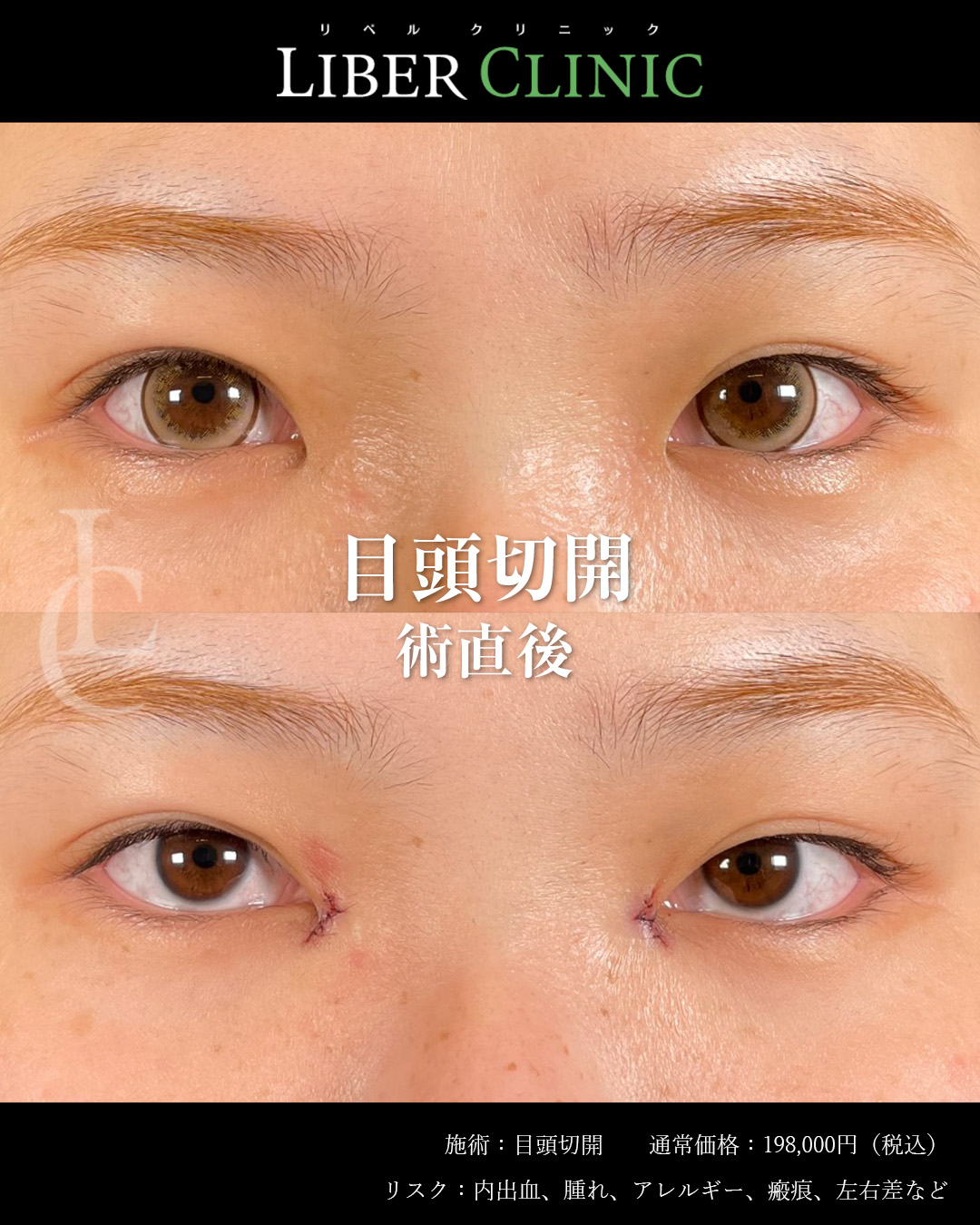 手術前と術直後