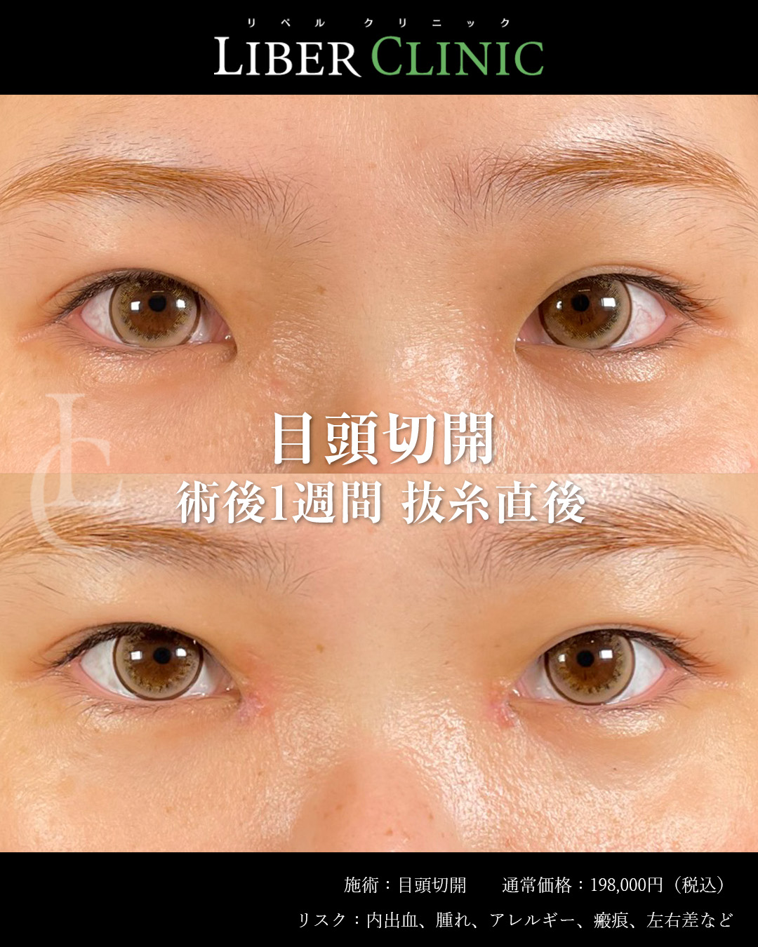 手術前と術後1週間抜糸直後