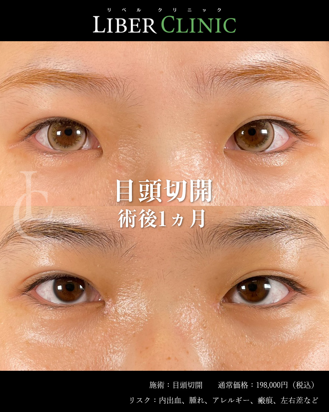手術前と術後1ヵ月