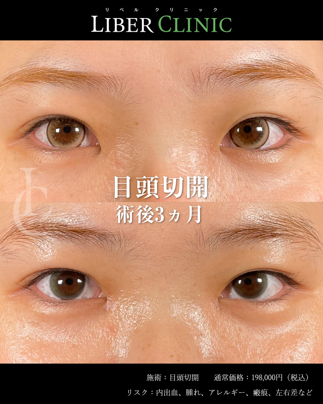 手術前と術後3ヵ月