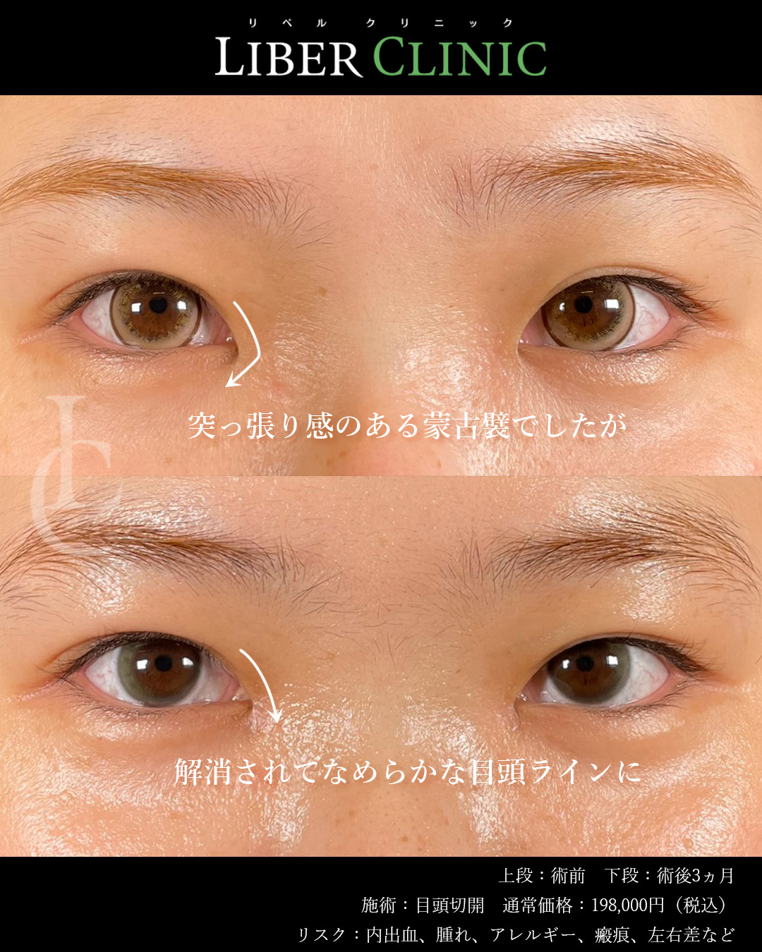 突っ張り感のある蒙古襞が解消されて、なめらかな目頭ラインに
