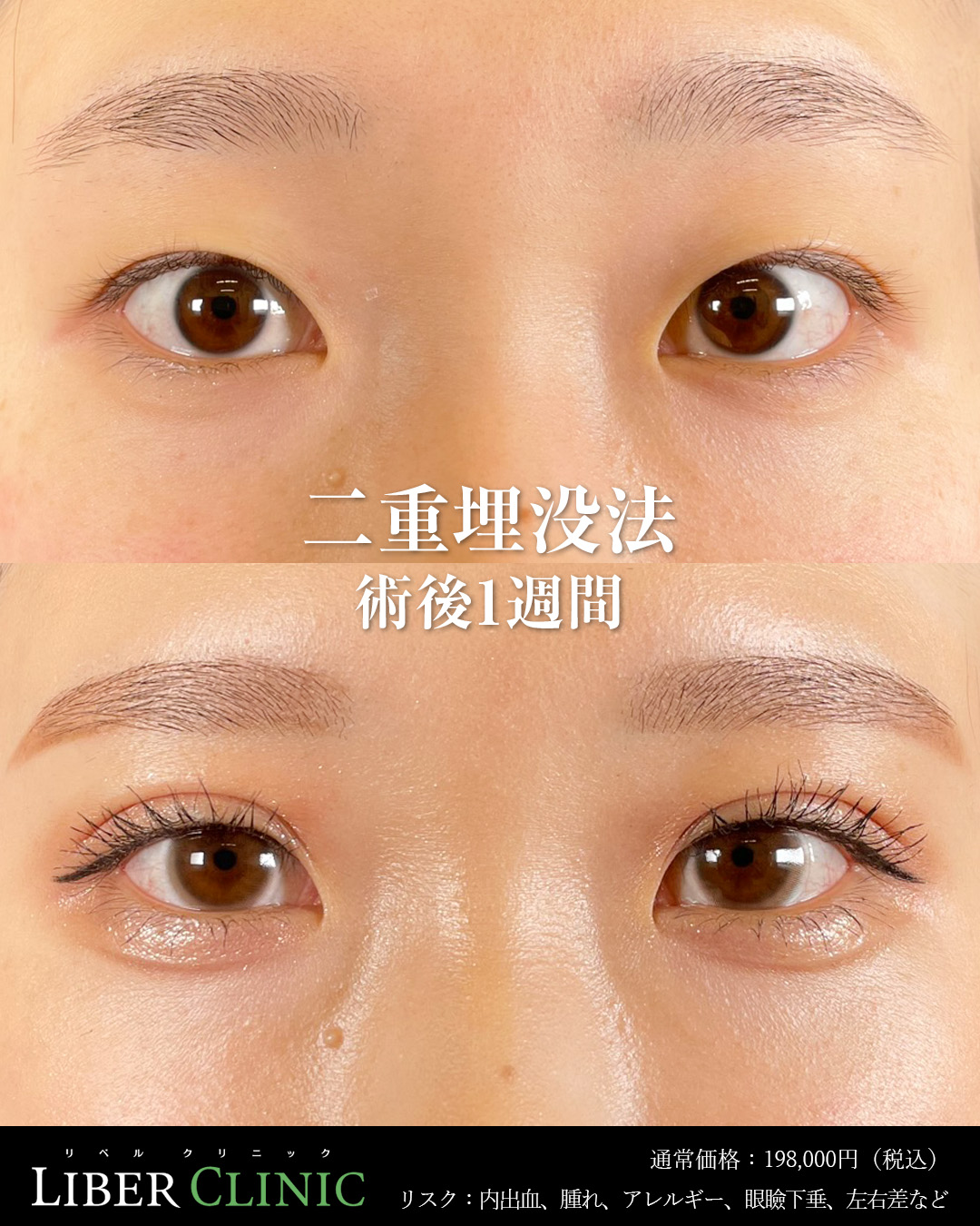 手術前と術後1週間