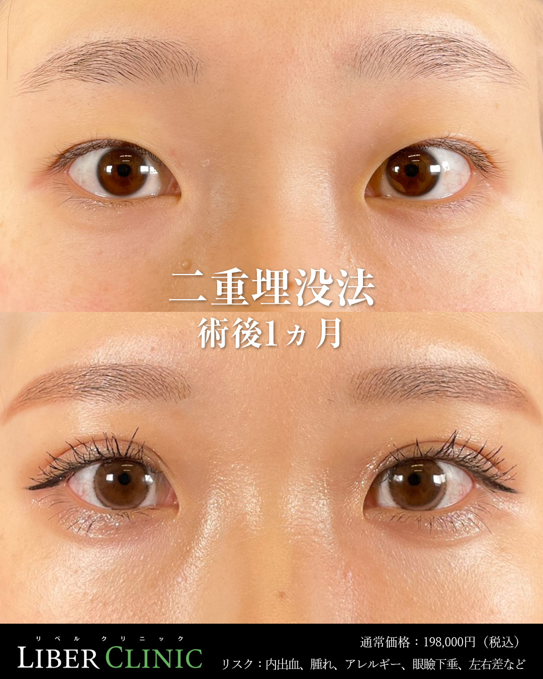 手術前と術後1ヵ月