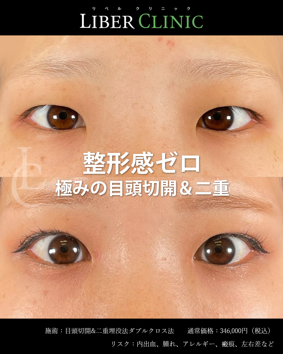 整形感ゼロ極みの目頭切開＆二重埋没