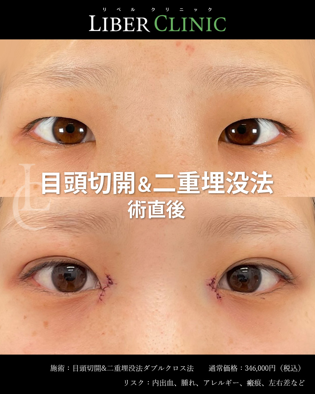 手術前と術直後