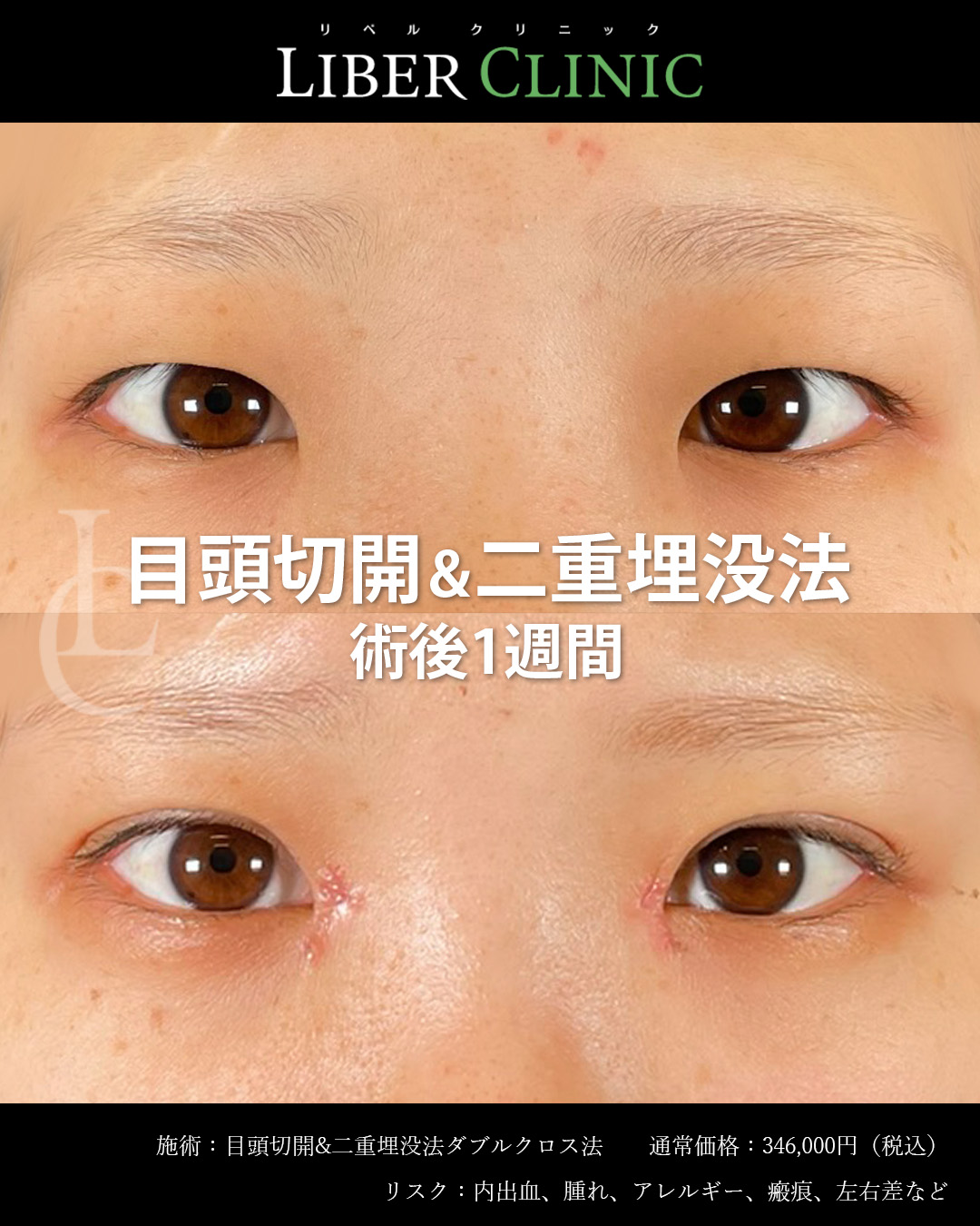 手術前と術後1週間