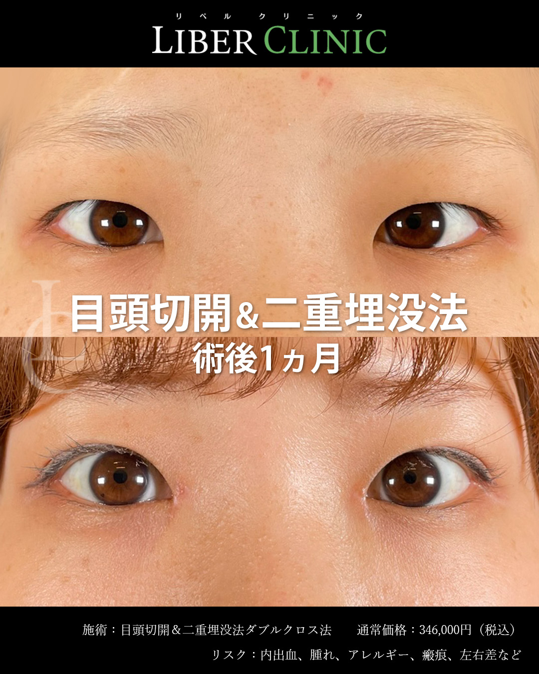 手術前と術後1ヵ月