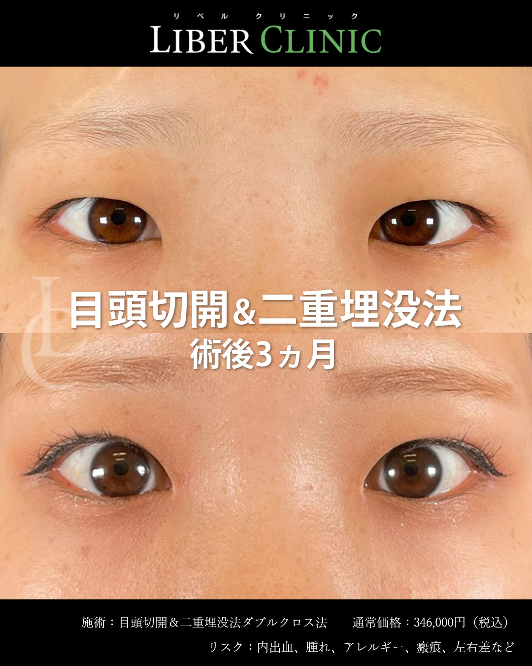 手術前と術後3ヵ月