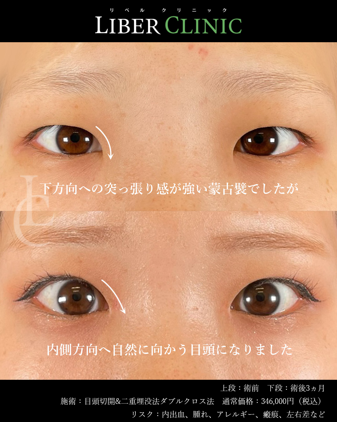 下方向への突っ張り感が強い蒙古襞が内側方向へ自然に向かう目頭になりました
