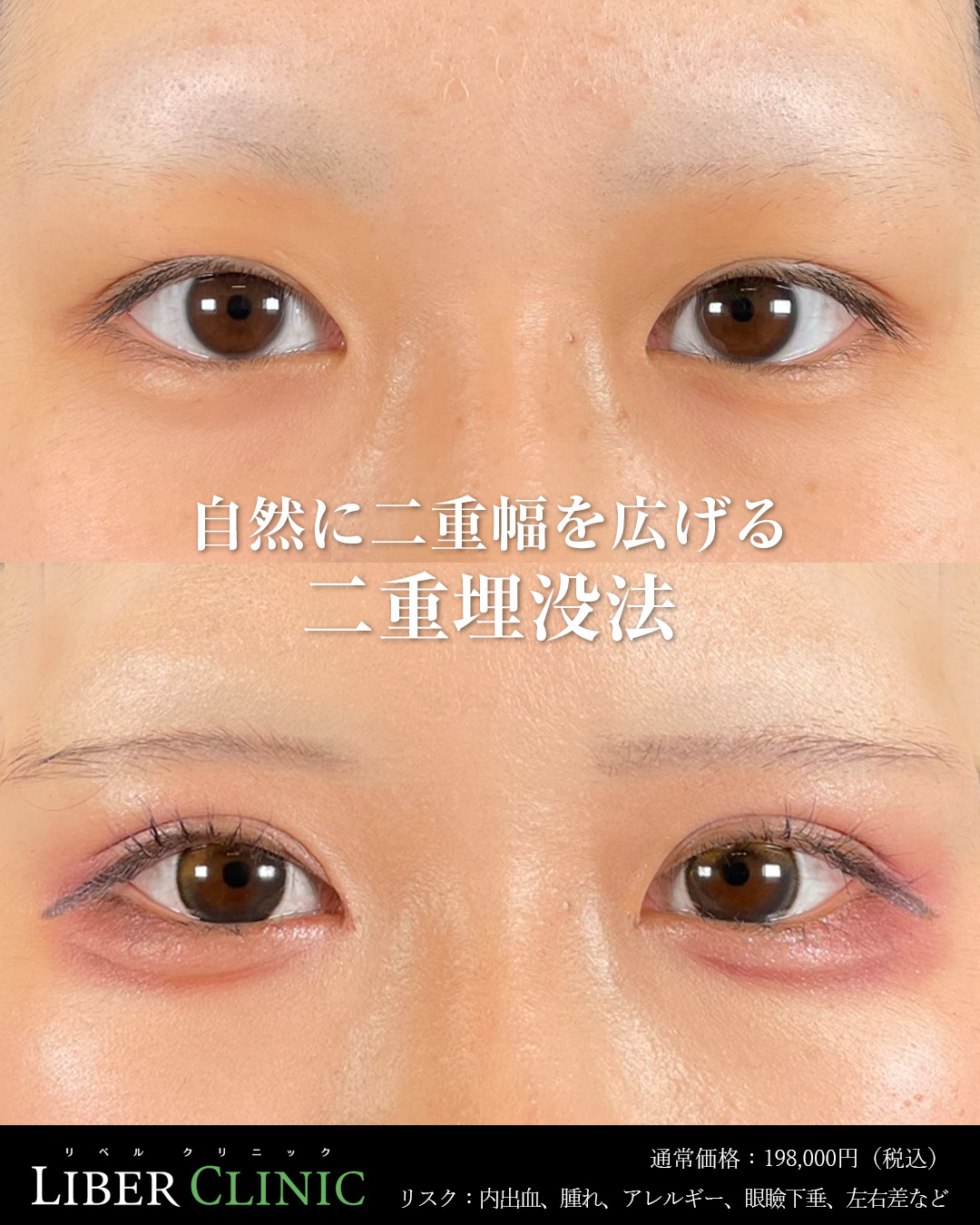 自然に二重幅を広げる二重埋没法