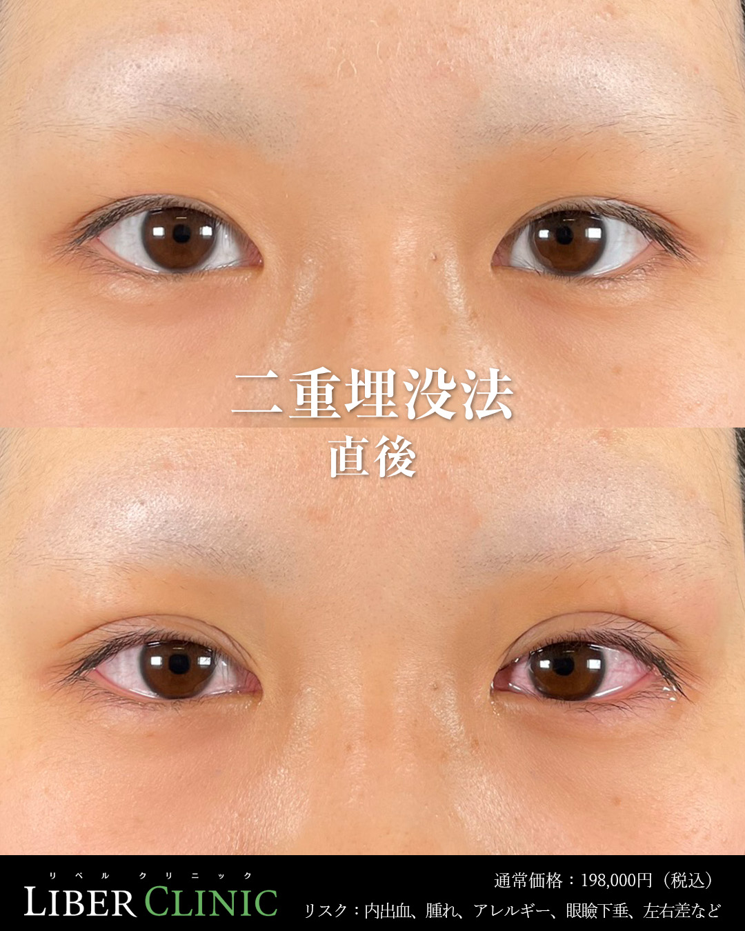 手術前と術直後