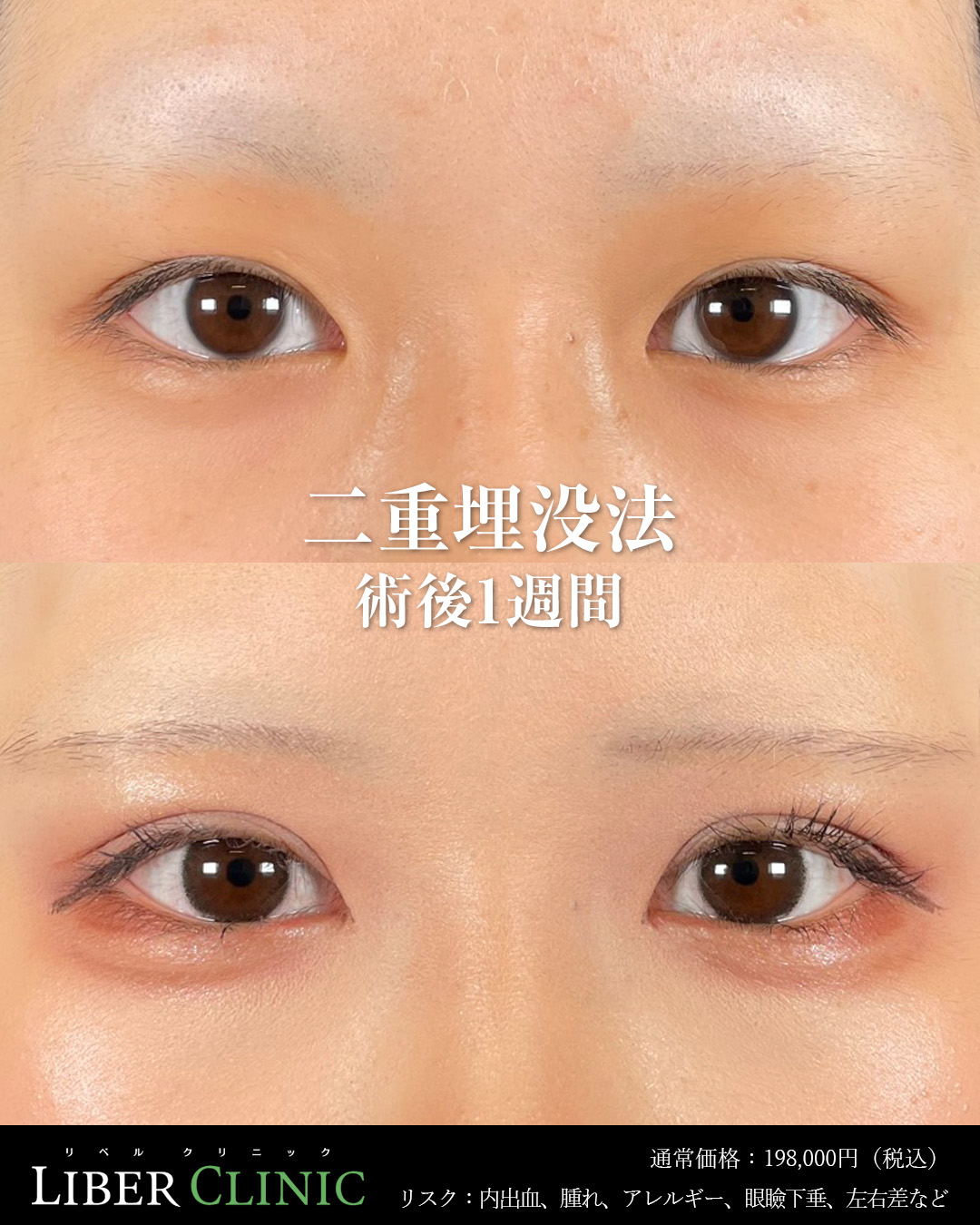 手術前と術後1週間
