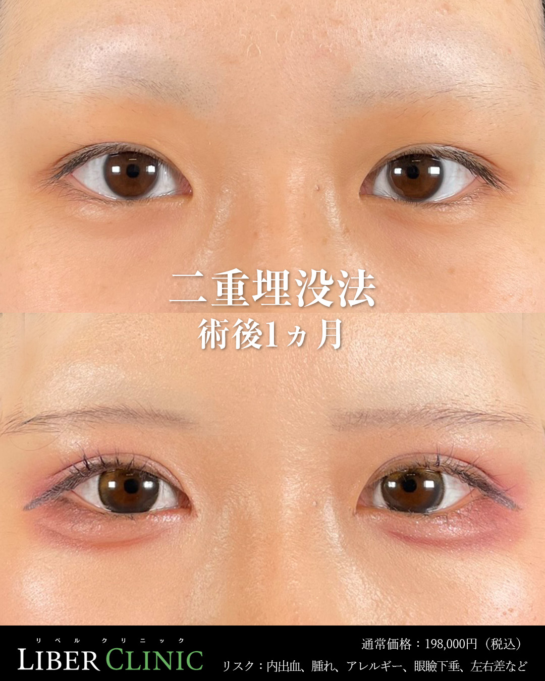 手術前と術後1ヵ月