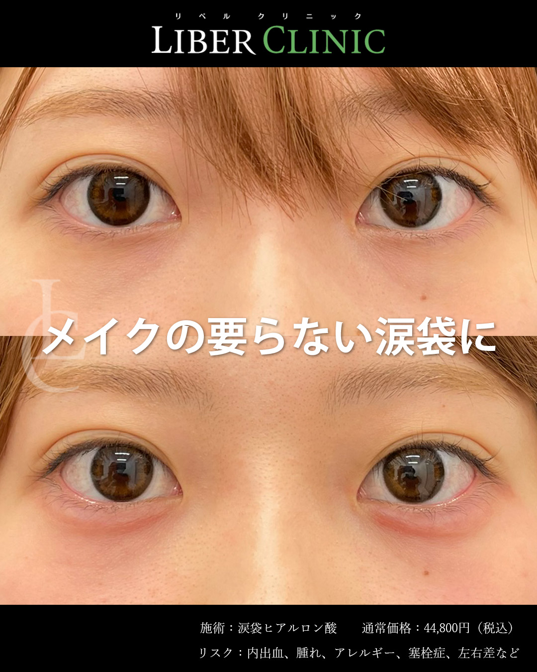 メイクの要らない涙袋に