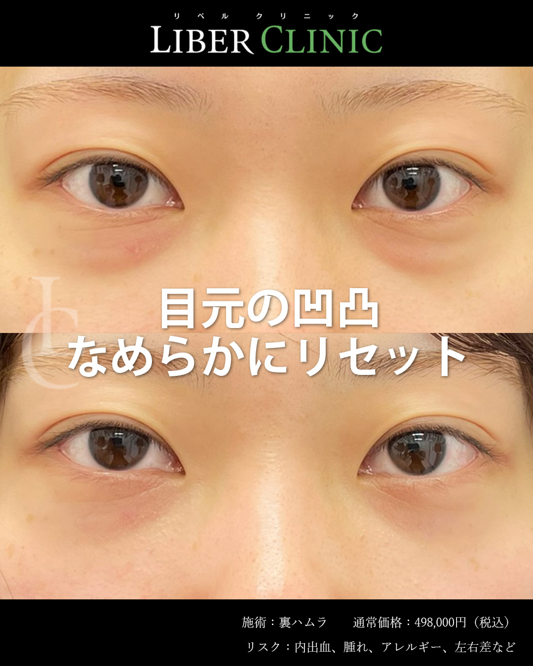裏ハムラで目元の凹凸なめらかにリセット