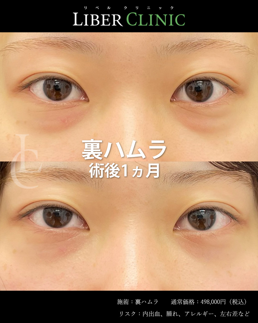 手術前と術後1ヵ月