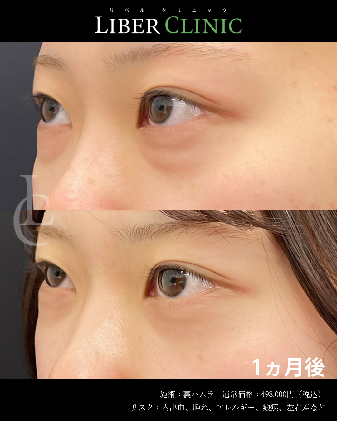 手術前と術後1ヵ月