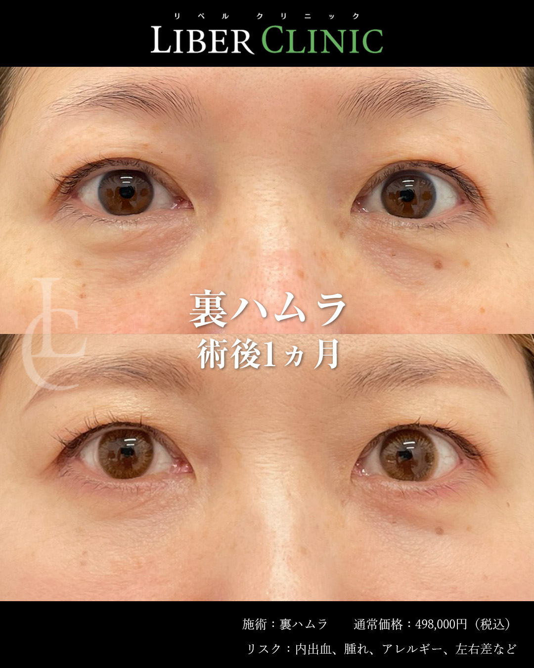 手術前と術後1ヵ月