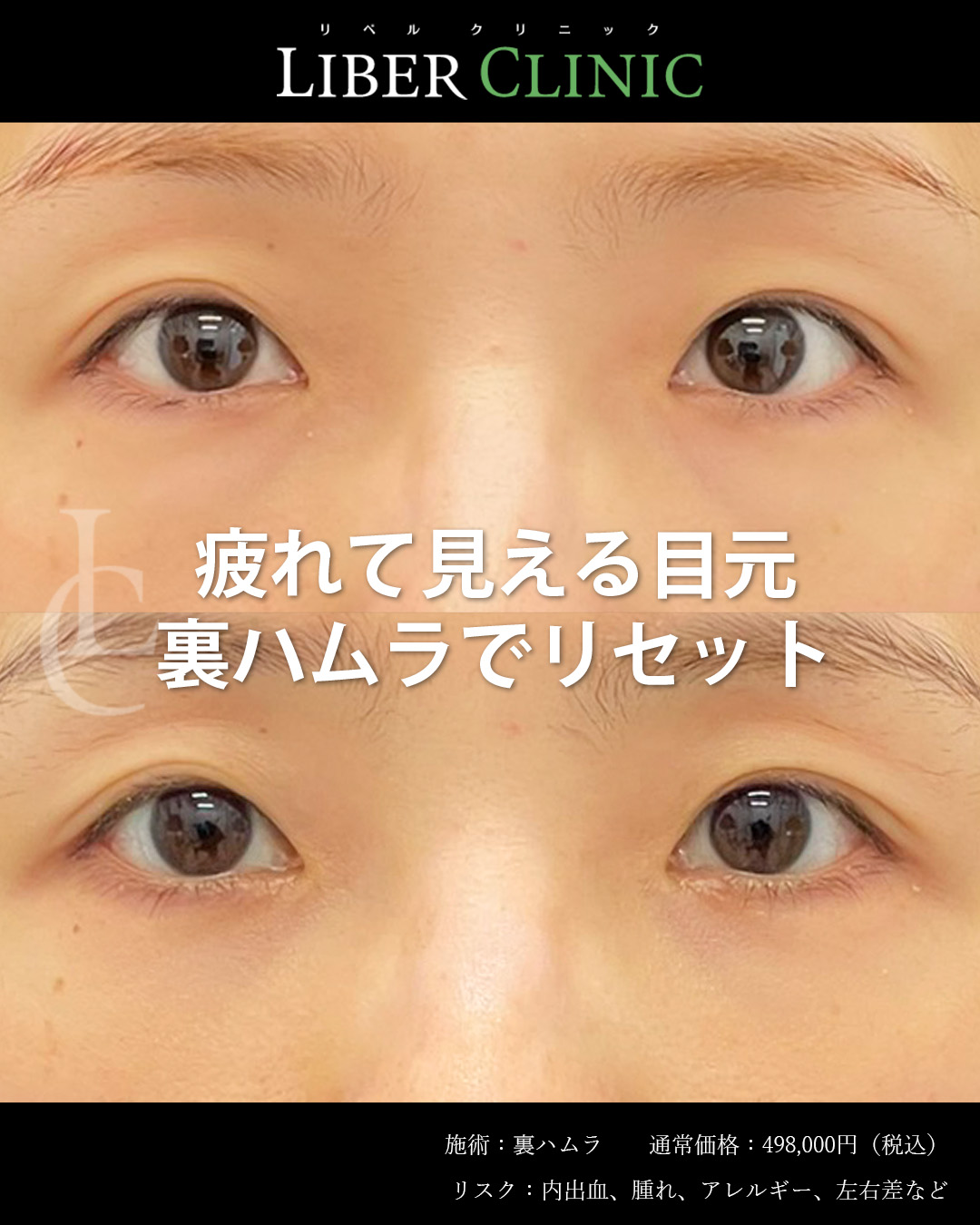 疲れて見える目元を裏ハムラでリセット