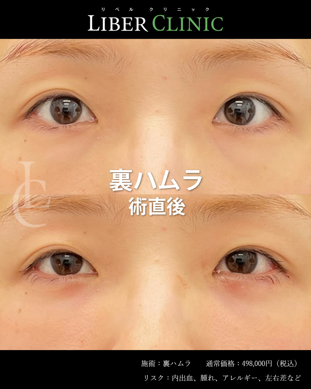 手術前と術直後