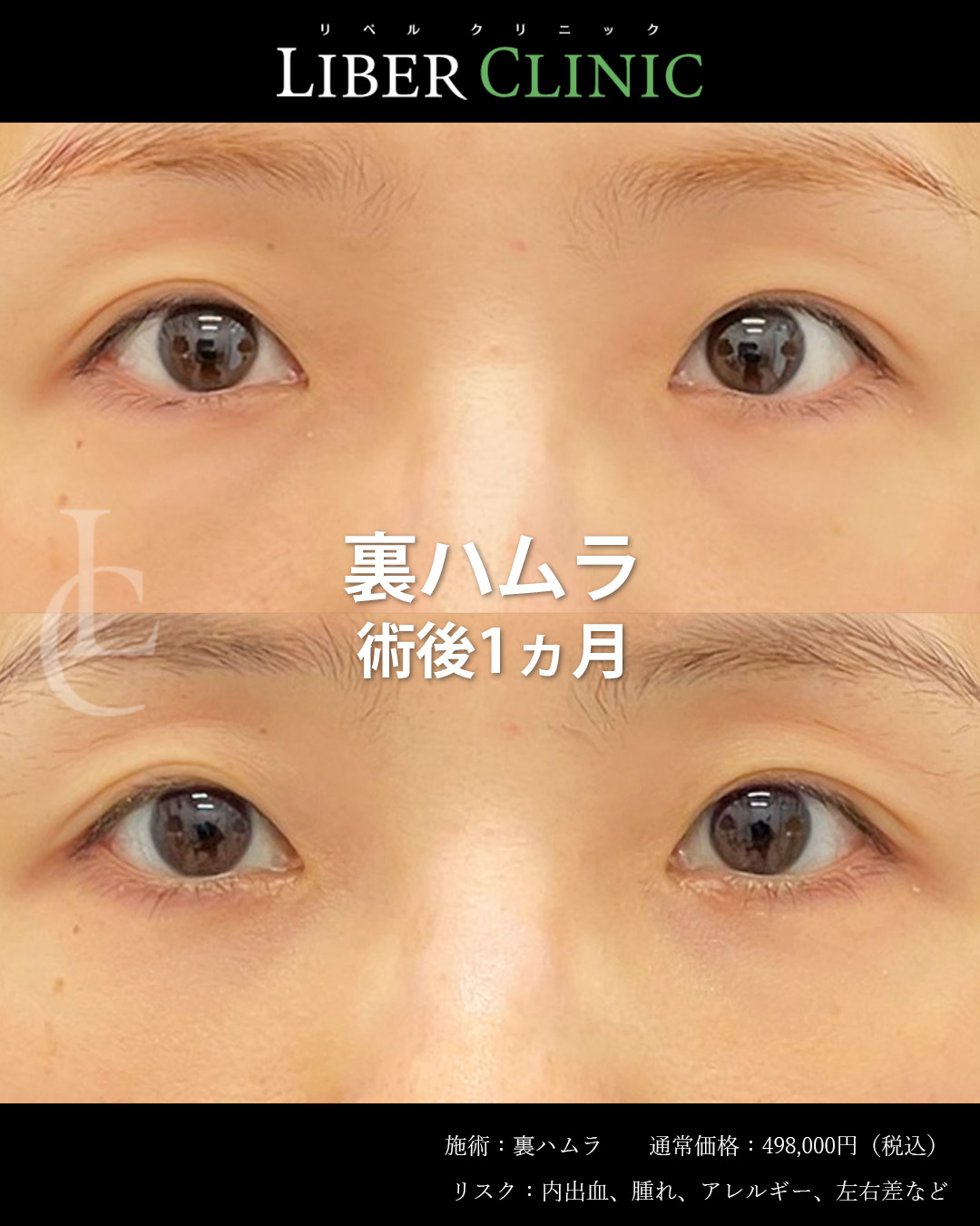 手術前と術後1ヵ月