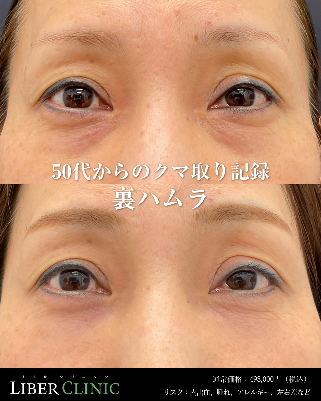 50代目の下のクマ取り記録裏ハムラ
