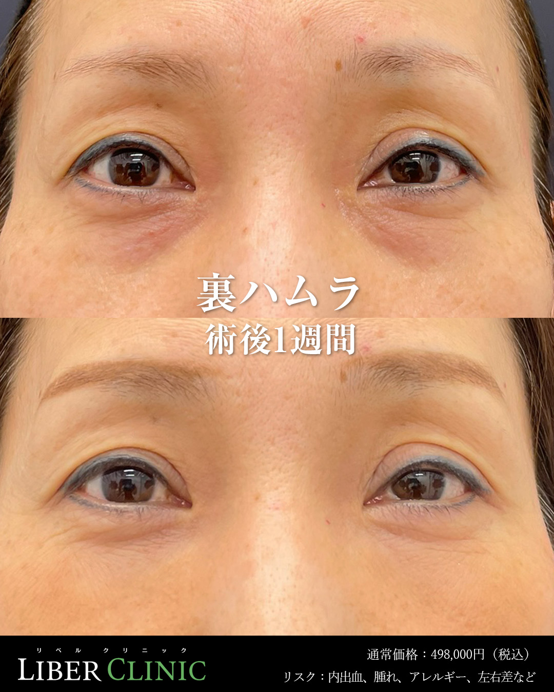 手術前と術後1週間