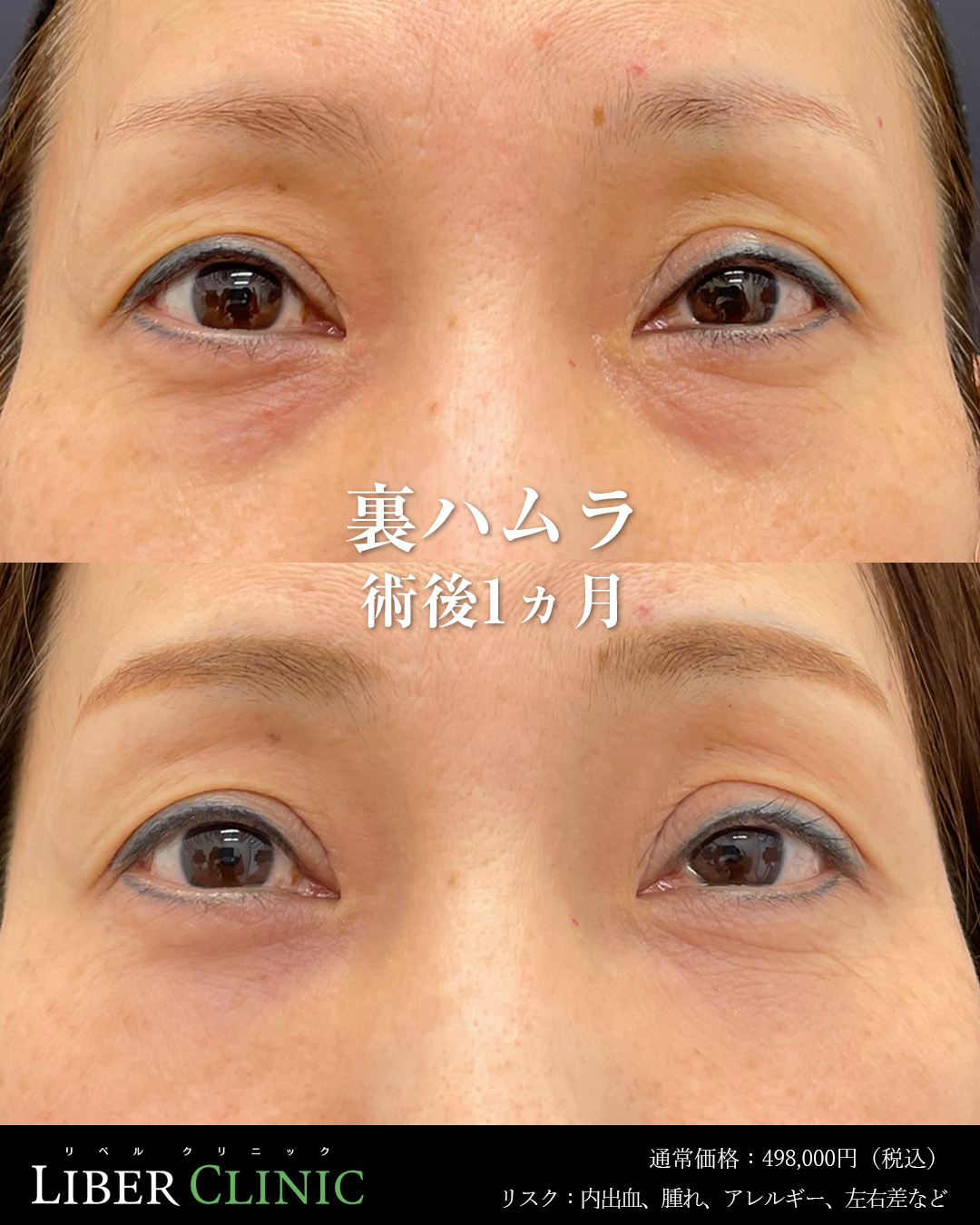 手術前と術後1ヵ月