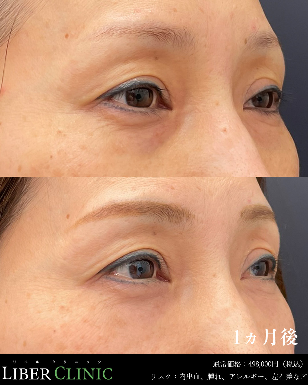 手術前と術後1ヵ月