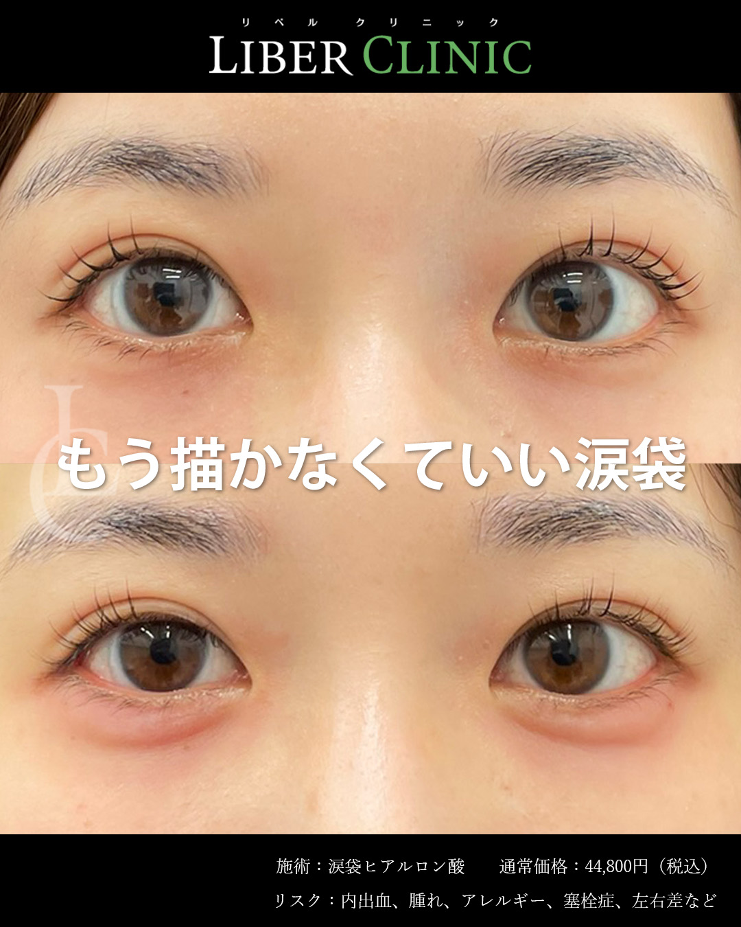涙袋ヒアルで涙袋メイクはもういらない