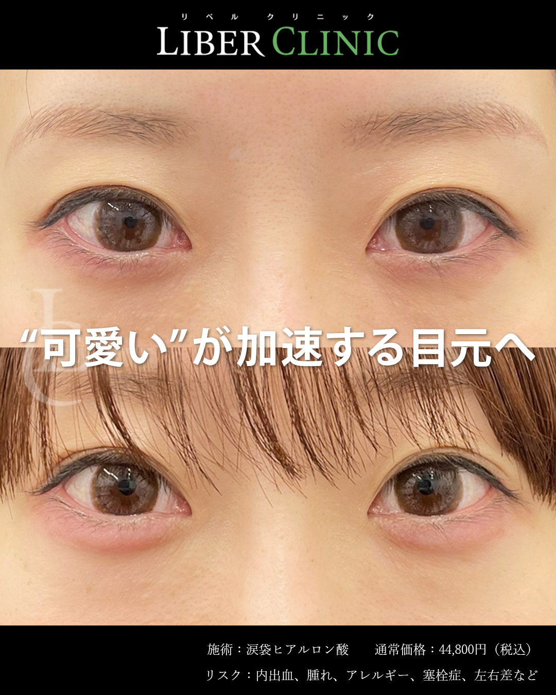 涙袋ヒアルで“可愛い”が加速する目元へ