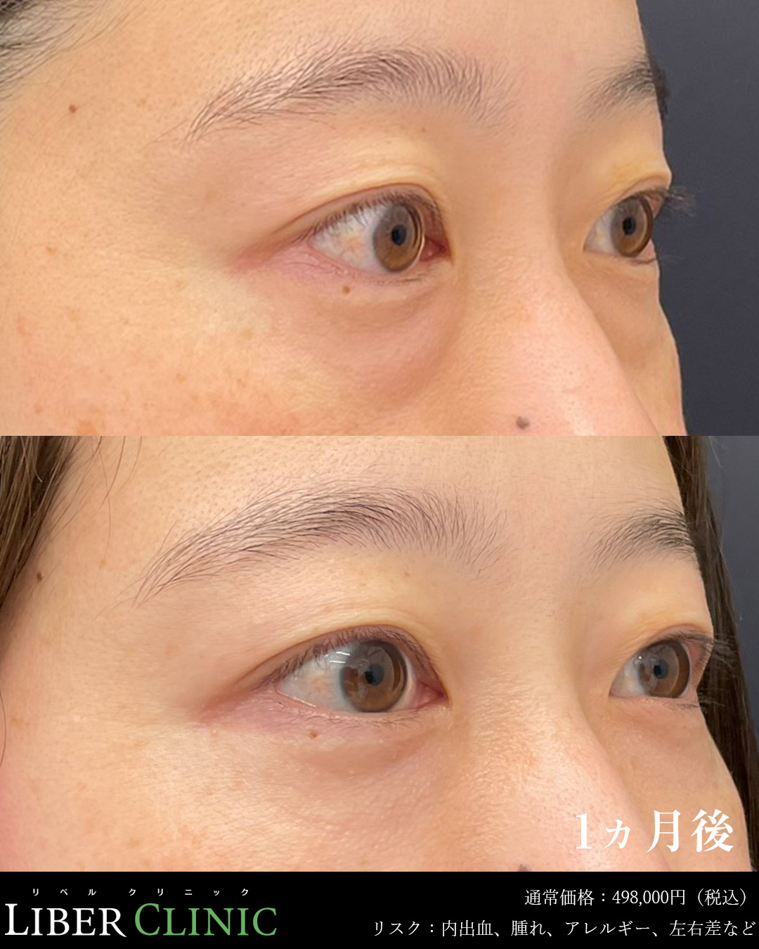 手術前と術後1ヵ月