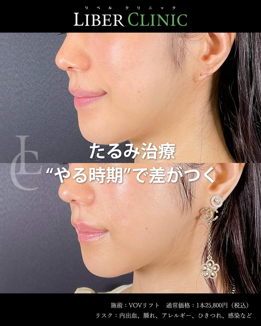 たるみ治療“やる時期”で差がつく