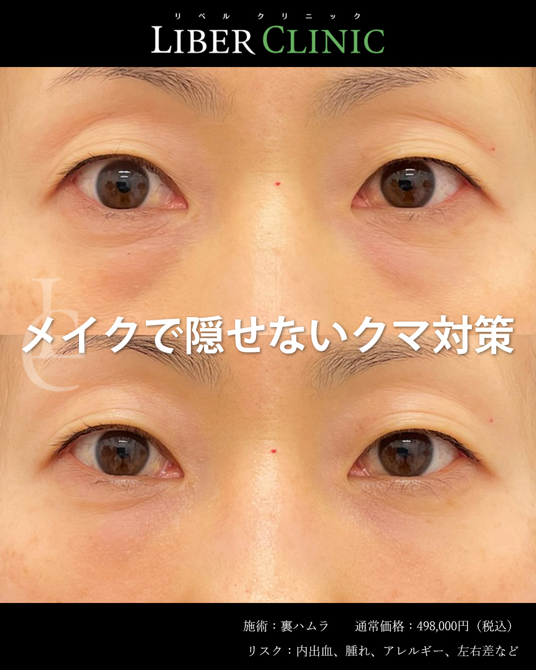 メイクで隠せないクマ対策