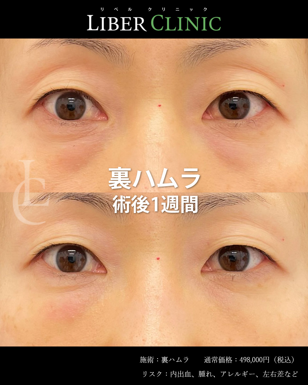 手術前と術後1週間