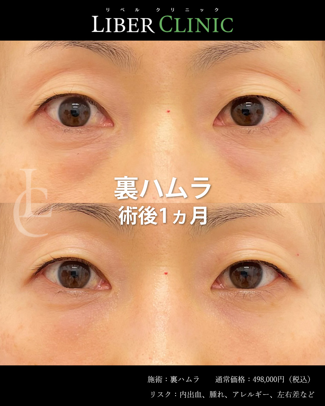 手術前と術後1ヵ月