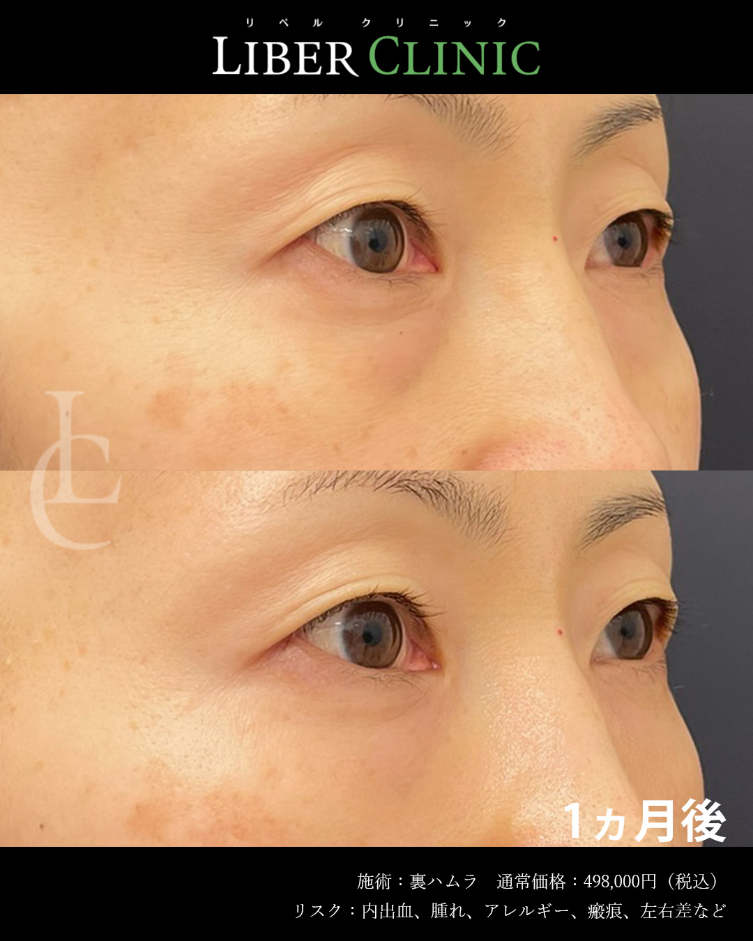 手術前と術後1ヵ月