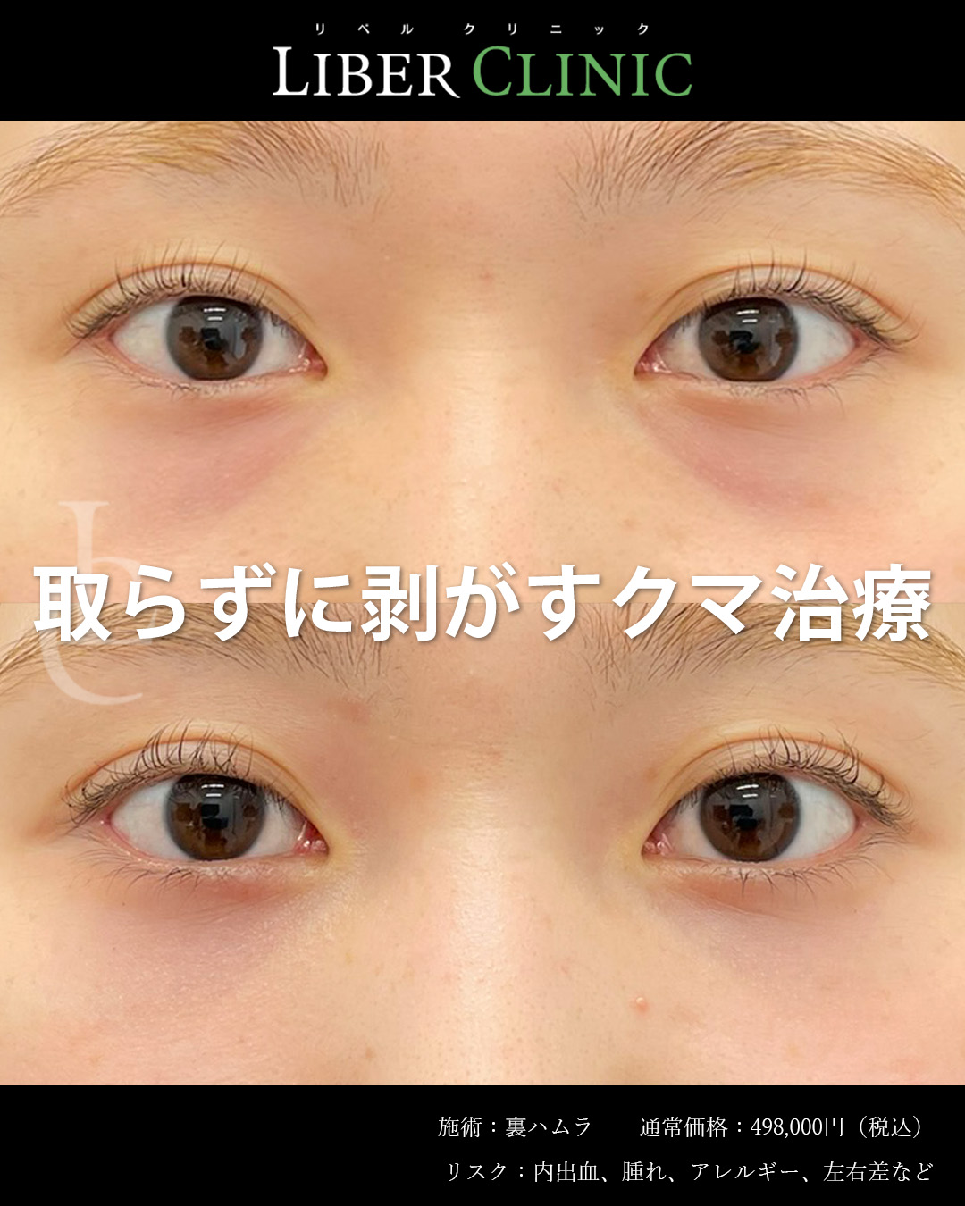 取らずに剥がすクマ治療