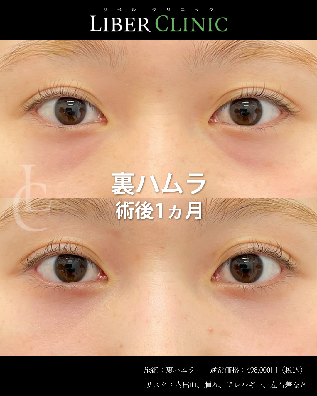 手術前と術後1ヵ月