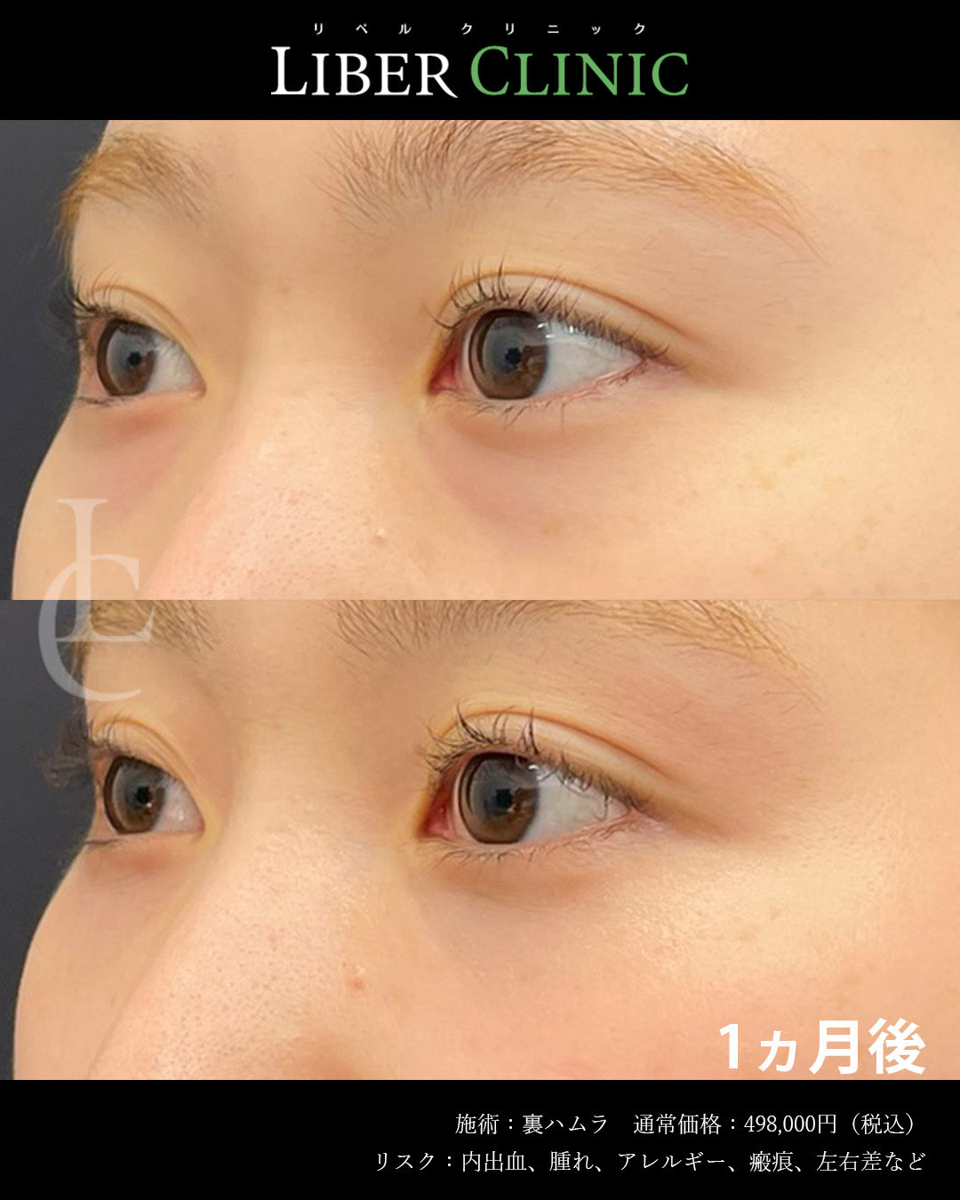 手術前と術後1ヵ月