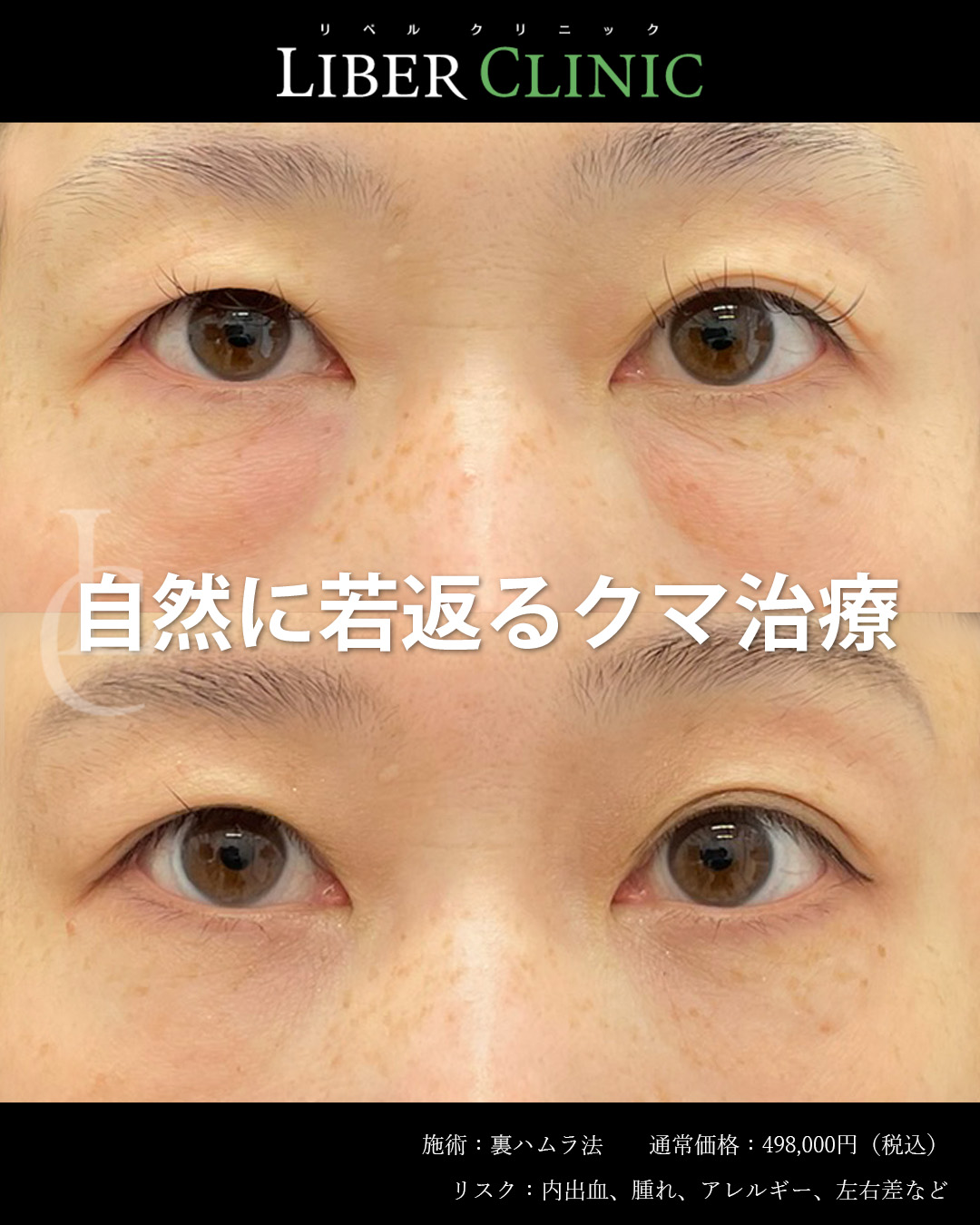 自然に若返るクマ治療