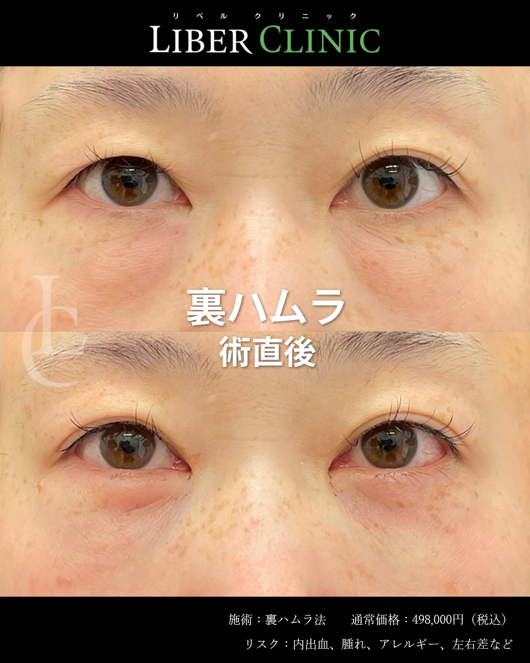 手術前と術直後