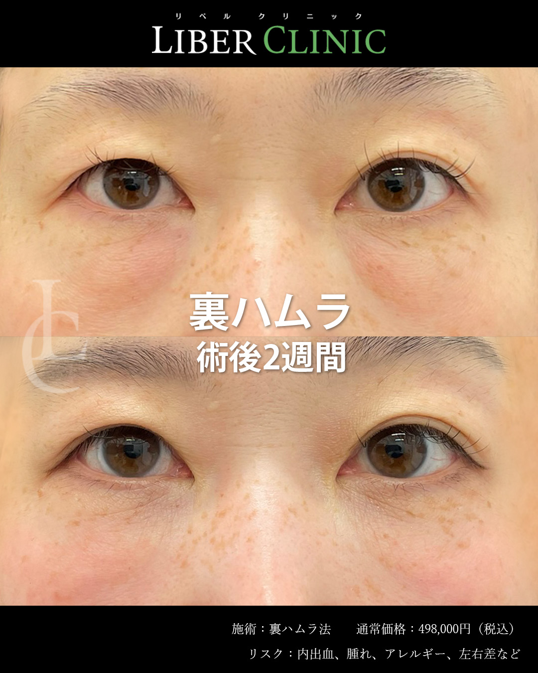 手術前と術後2週間