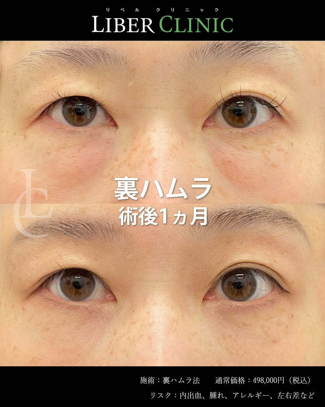 手術前と術後1ヵ月