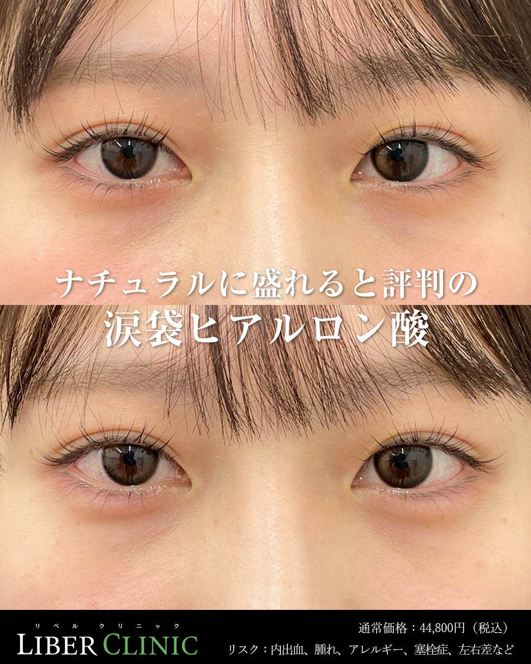 ナチュラルに盛れると評判の涙袋ヒアルロン酸注射