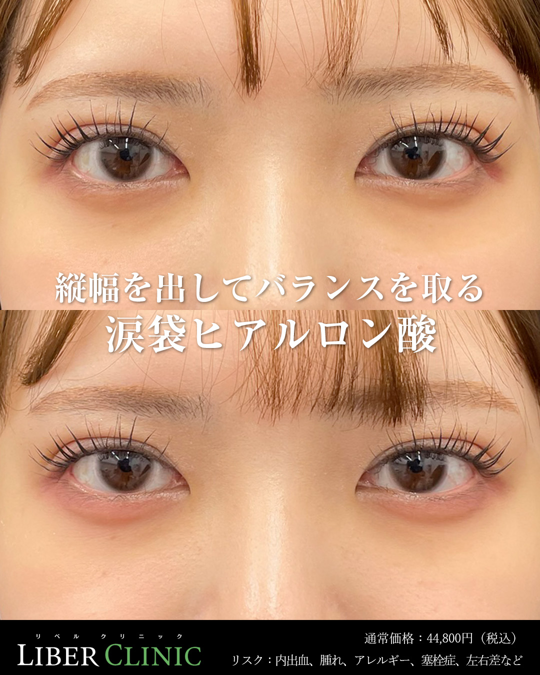 縦幅を出してバランスを取る涙袋ヒアルロン酸注射