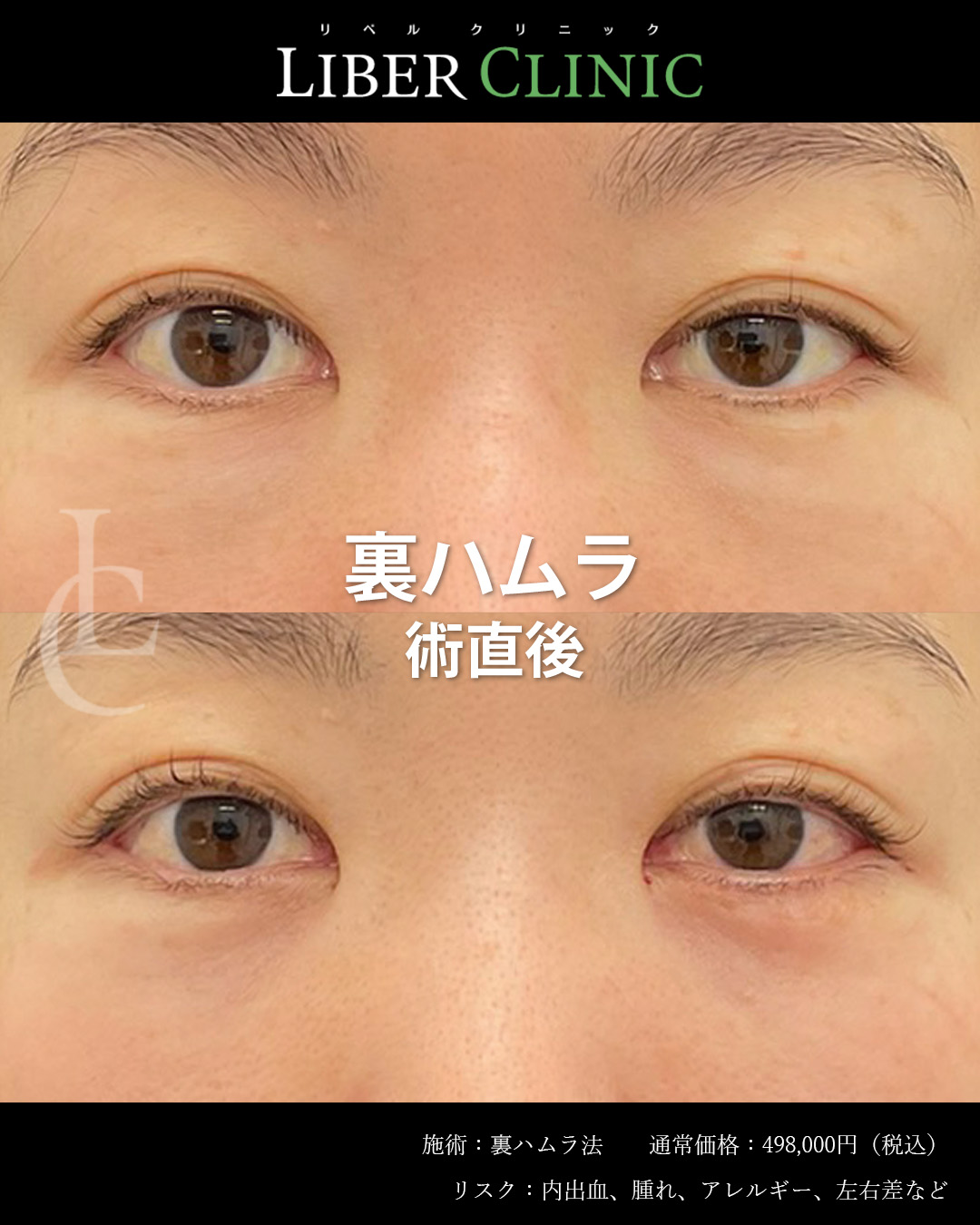 手術前と術直後