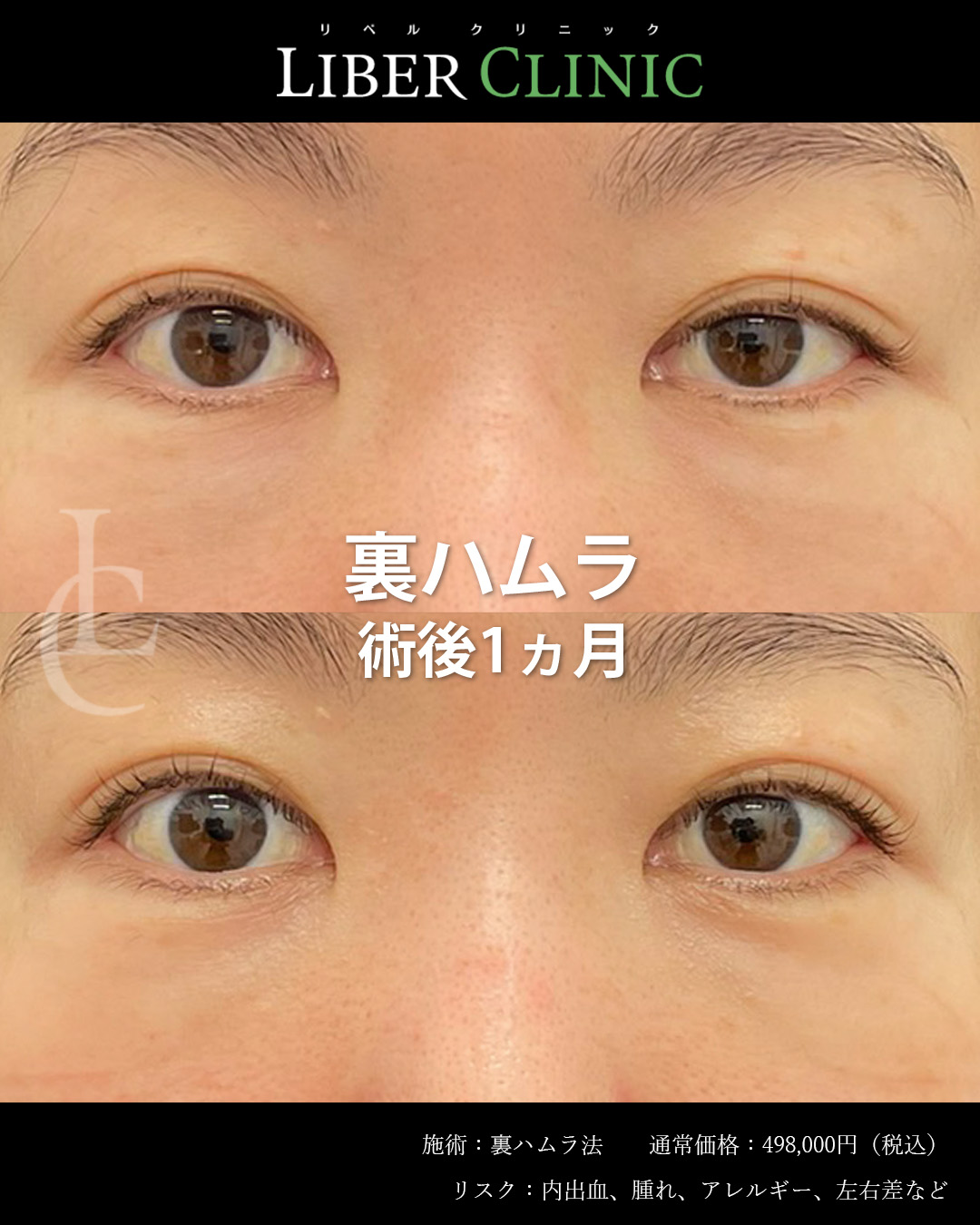 手術前と術後1ヵ月