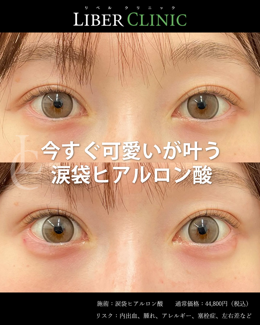 今すぐ可愛いが叶う涙袋ヒアルロン酸