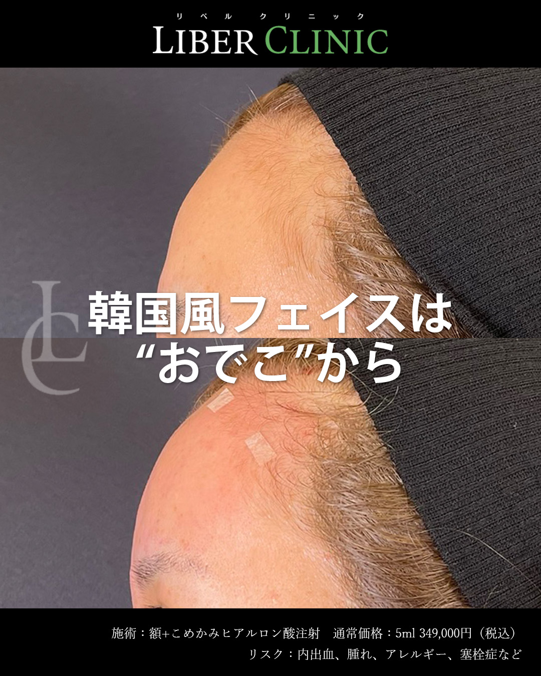 韓国風フェイスはおでこから